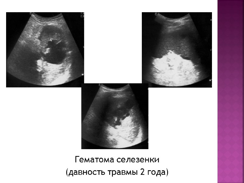 Гематома селезенки  (давность травмы 2 года)